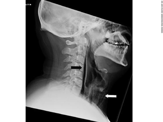 One man ruptured his throat by trying to hold back a sneeze